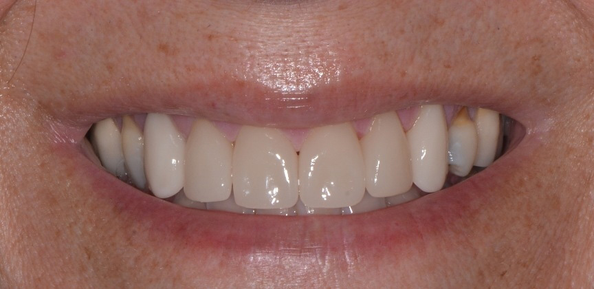 Yellowed and damaged smile before cosmetic dental treatment