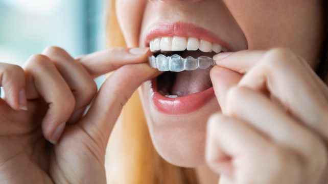 Patient placing an Invisalign tray in their mouth