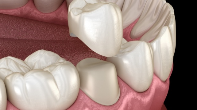Animated dental crown being placed on a tooth