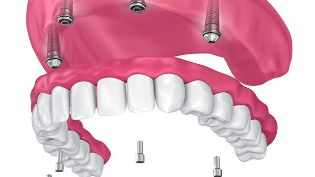 Illustrated model of implant denture in Colchester on upper arch