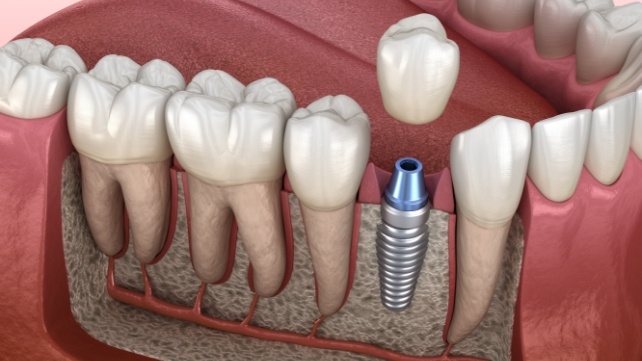 Illustrated dental crown being placed on a dental implant in Colchester