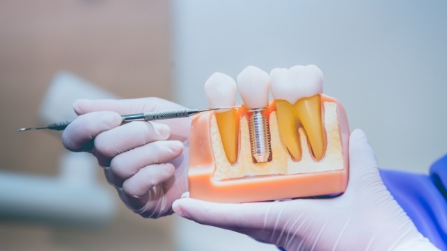 Dentist holding a dental implant model
