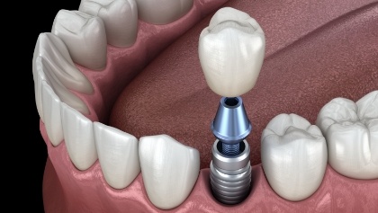Animated dental crown being placed onto a dental implant