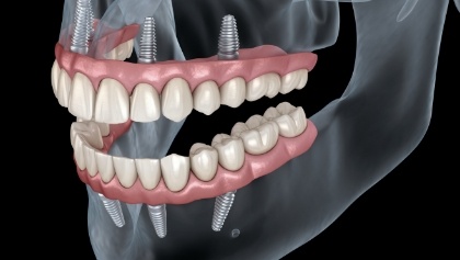 Animated implant denture replacing both arches of teeth