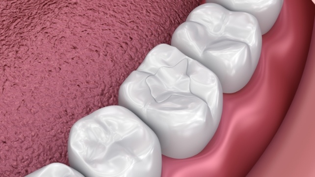 Animated teeth with tooth colored fillings