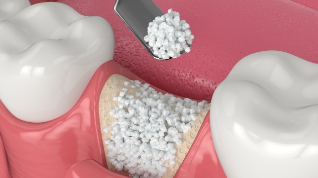 Animated bone grafting material being placed into tooth extraction site