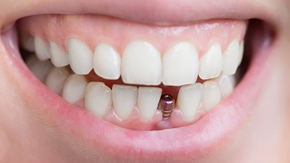Closeup of a dental implant