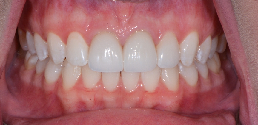  teeth before dental treatment