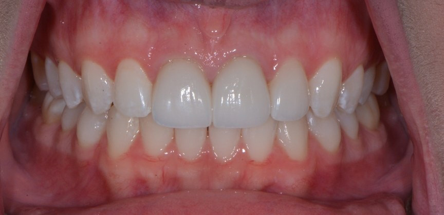 Discolored smile before treatment treatment