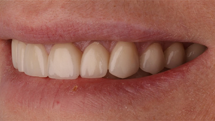 After image of Porcelain Crowns
