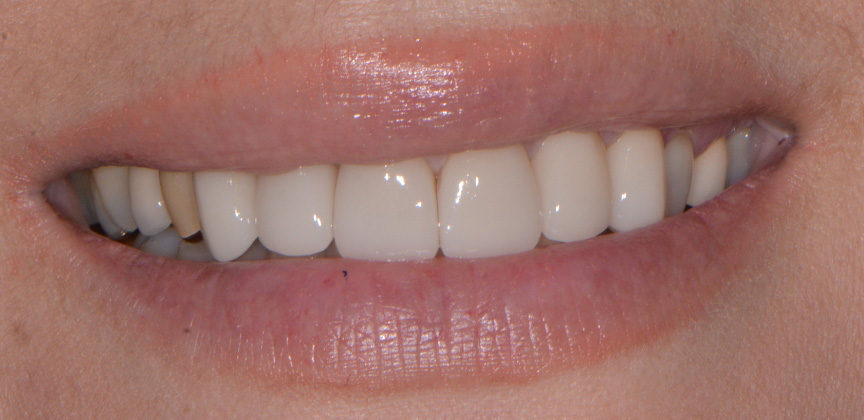 Smile after restorative dental treatment