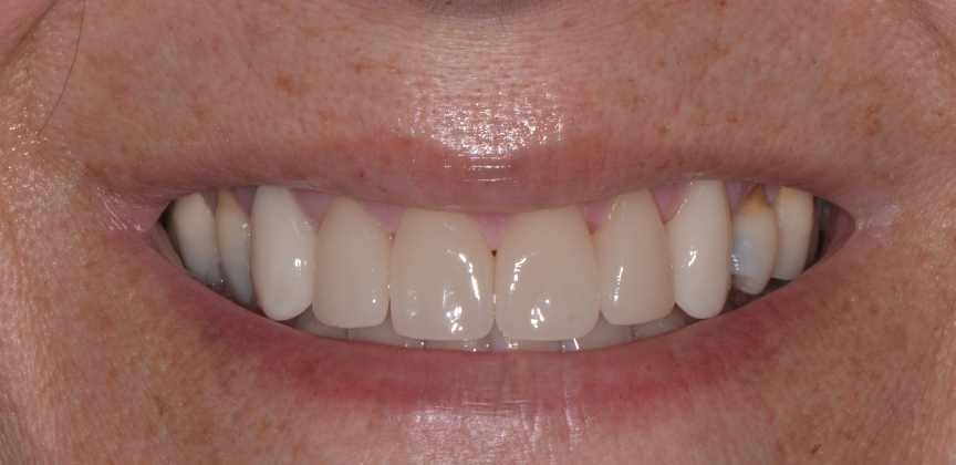  teeth before dental treatment