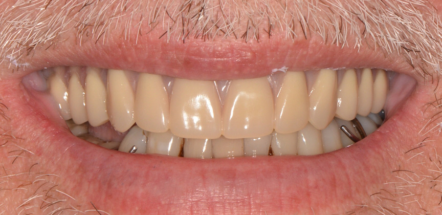 Smile with damaged decayed and missing teeth before dental treatment