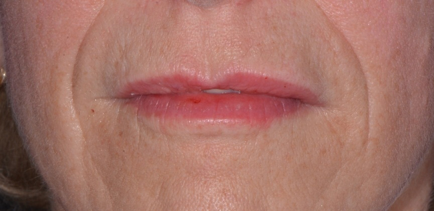 Mouth surrounded by wrinkles before Botox treatment