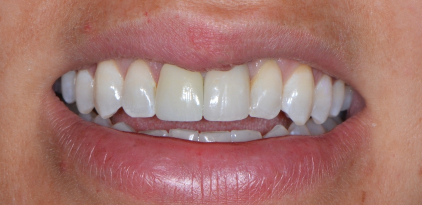  teeth before dental treatment