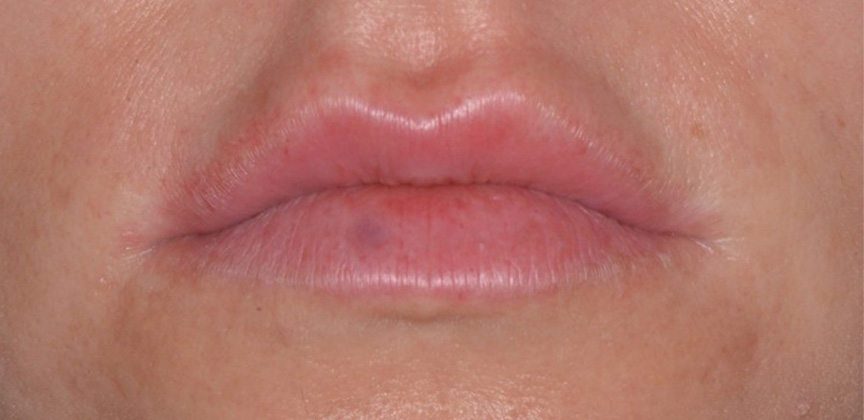 Lips before dermal filler treatment