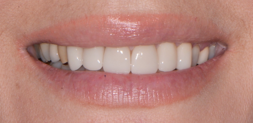  teeth before dental treatment