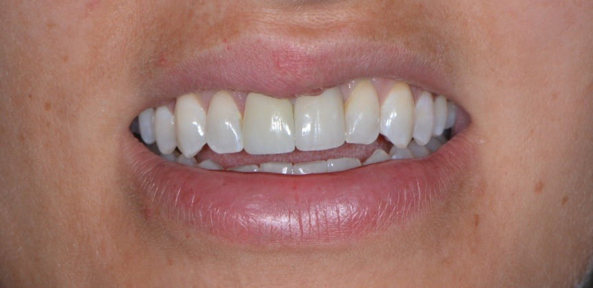 Yellowed smile before teeth whitening treatment