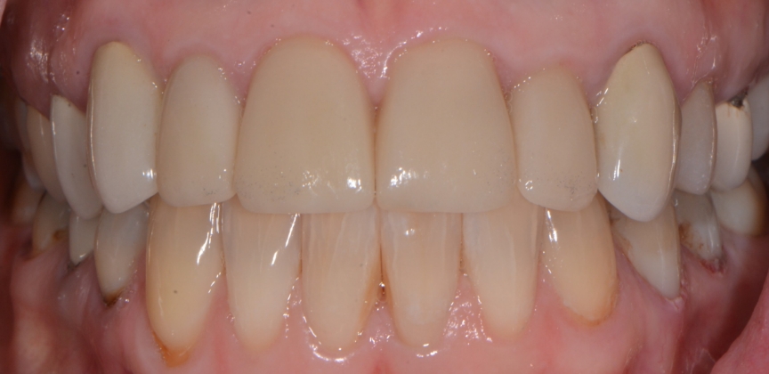  teeth before dental treatment