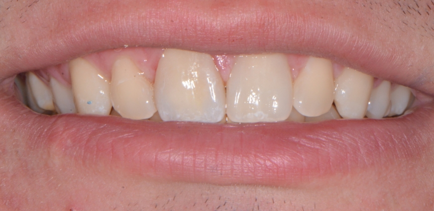  teeth before dental treatment