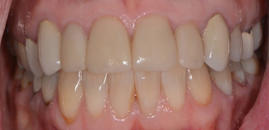 Severely decayed and damaged smile before restorative dental treatment