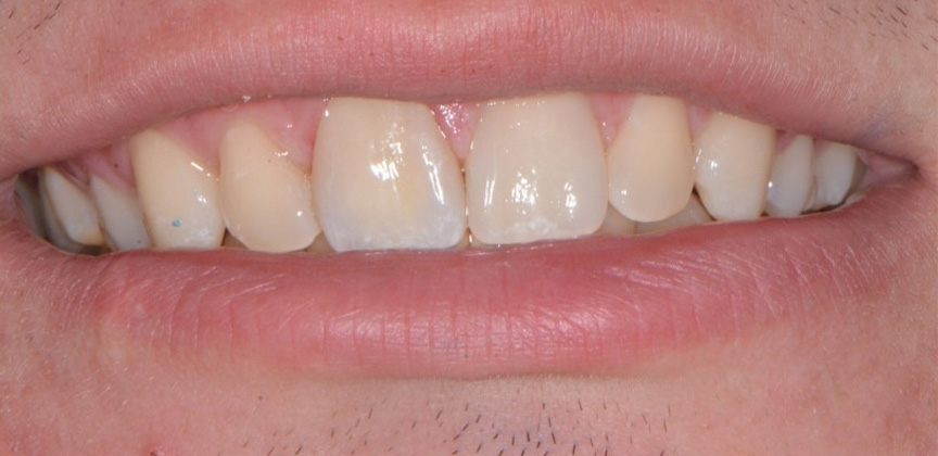 Smile with worn and damaged front tooth before treatment