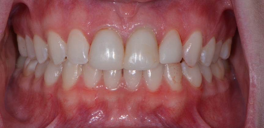 Smile after dental treatment
