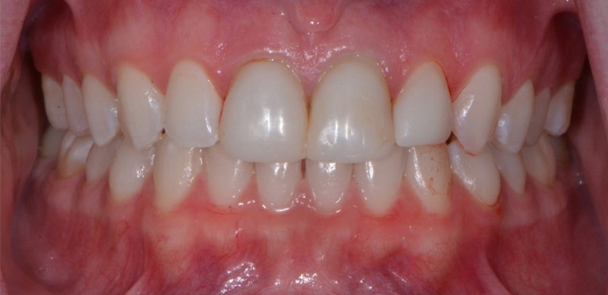 Healthy bright natural looking some after cosmetic dentistry treatment