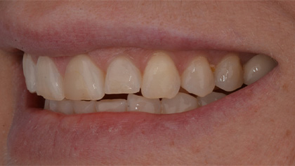 Before image of Porcelain Crowns