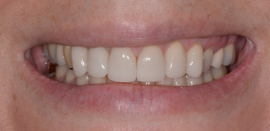 Smile with damaged decayed and missing teeth before dental treatment