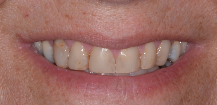 Smile after dental treatment