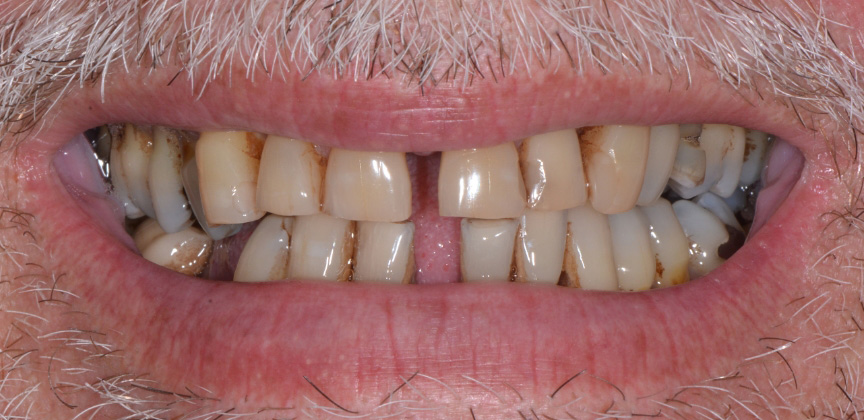 Smile after restorative dental treatment