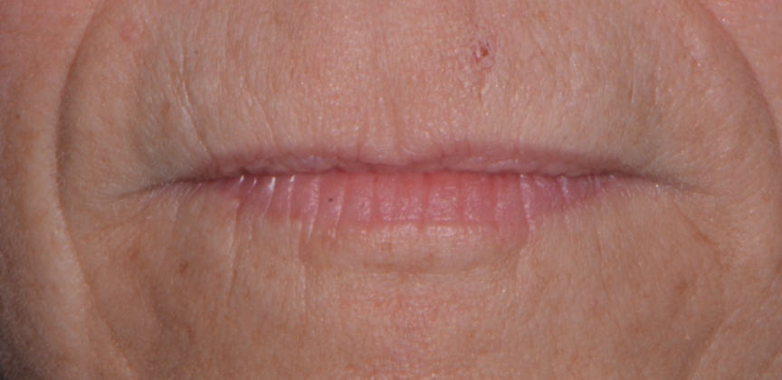 Smile after dental treatment