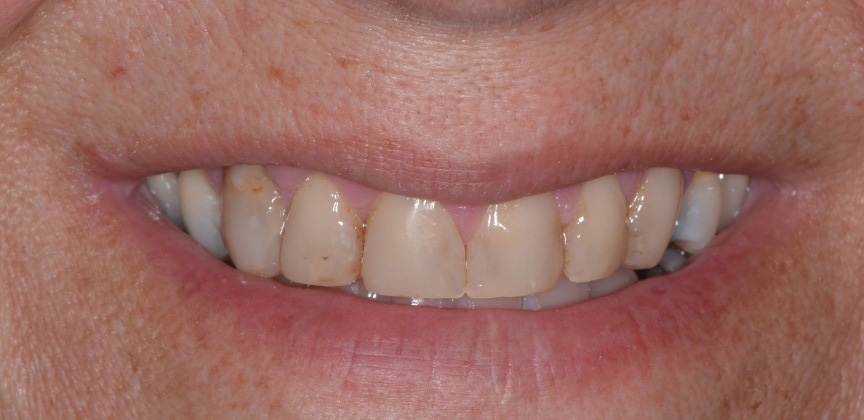 White healthy smile after cosmetic dental treatment