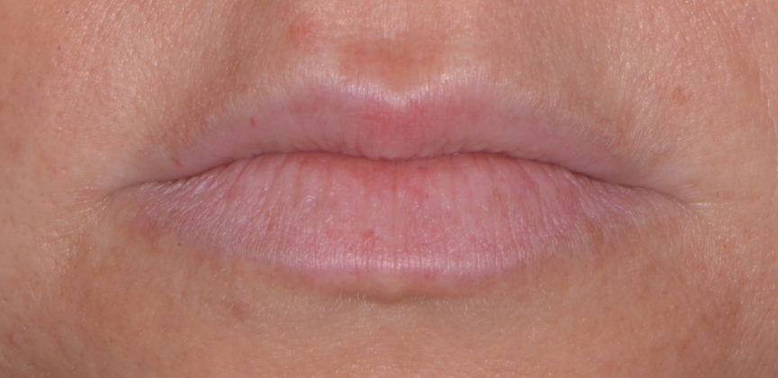 Smile after dental treatment