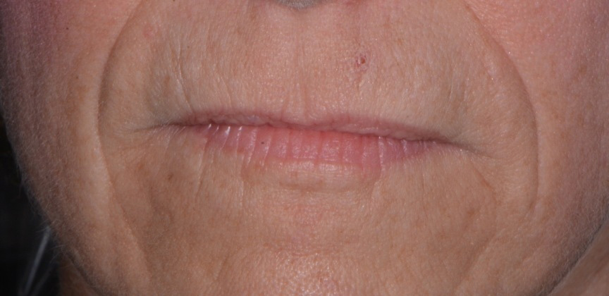 Smooth youthful skin around mouth after Botox treatment