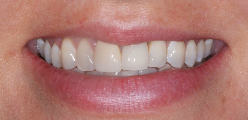 Smile after dental treatment