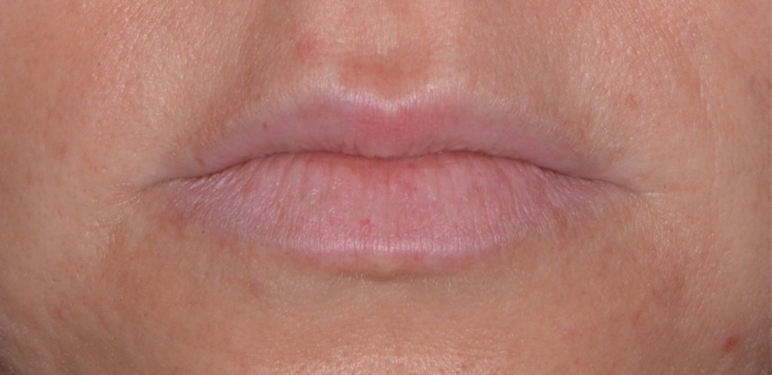 Plump lips after dermal filler treatment
