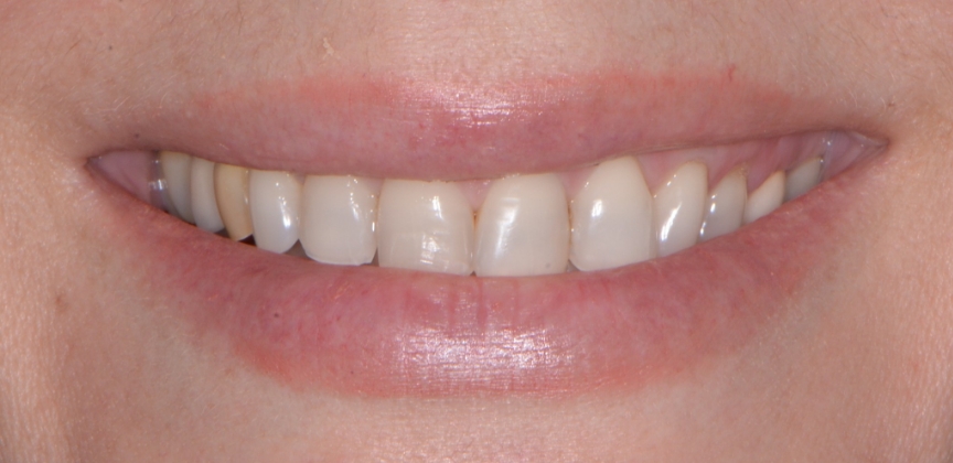 Smile after dental treatment
