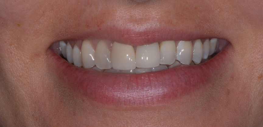 Bright smile after teeth whitening treatment