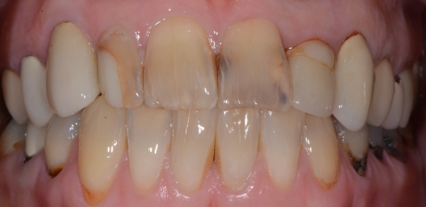 Smile after dental treatment