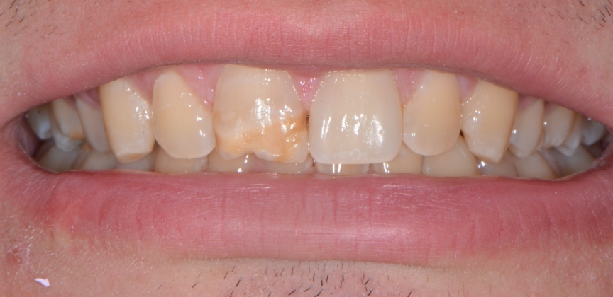 Smile after dental treatment