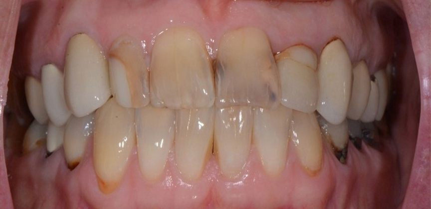 Healthy bright smile after restorative dental treatment