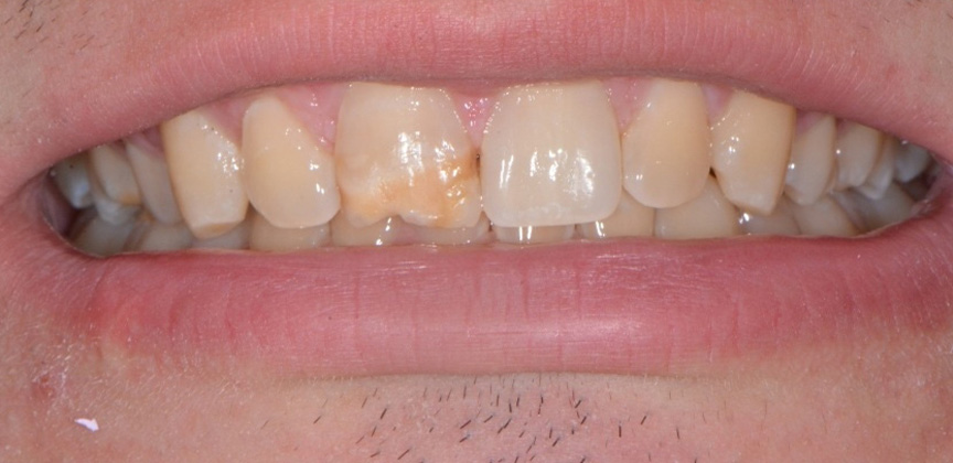 Perfected smile after damaged front tooth was repaired