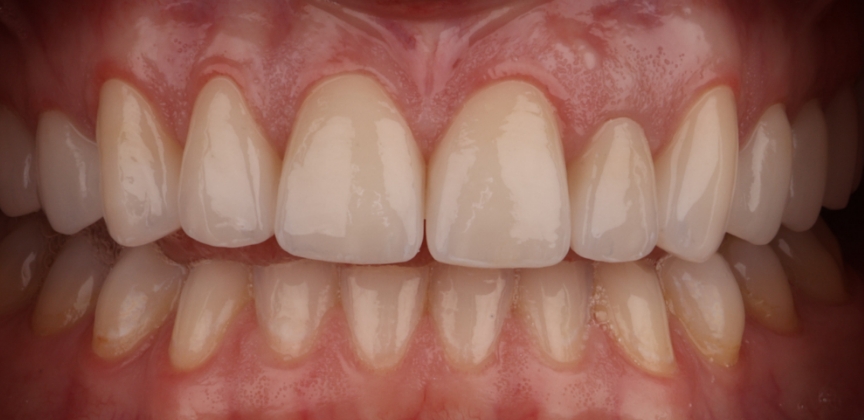 Smile with damaged decayed and missing teeth before dental treatment