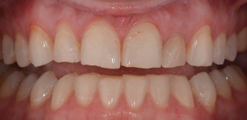 Smile after restorative dental treatment