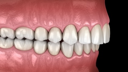 Animated smile with overbite