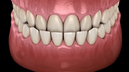 Animated smile with underbite