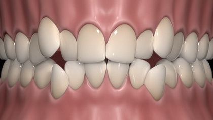 Animated smile with deviated dental midline