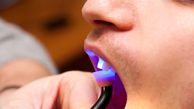 Close up of a dental patient receiving direct bonding on a front upper tooth